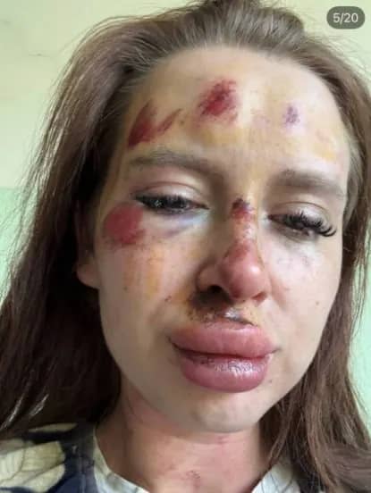 Женщина из Кавалерово публично рассказала о побоях со стороны мужа