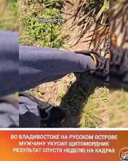 Мужчина показал последствия укуса щитомордника на острове Русский